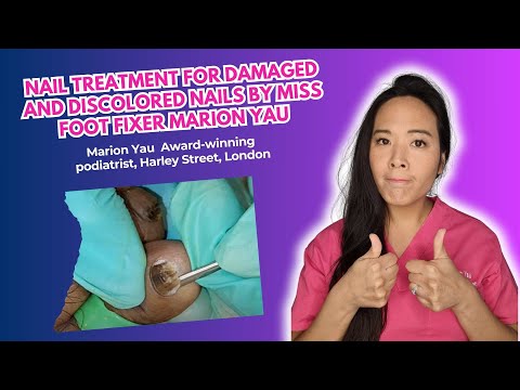 Nail treatment for damaged and discolored nails by Miss Foot Fixer Marion Yau