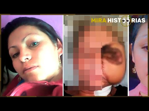 Lembra da mexicana que T0M0U INJEÇÃ0 de dentista e seu R0ST0 DESINTEGROU? A causa FOI CONFIRMADA