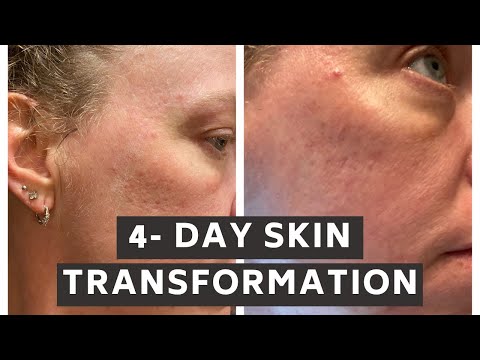 4327 4 Day Skin Transformation! Lighter Texture Anti