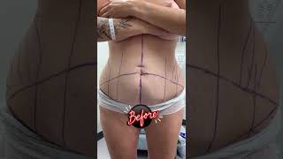 Tummy tuck on a mom with twins! See before and after surgery!