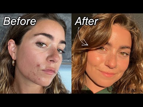 How I Cleared my Hormonal Acne in 1 Month *not sponsored*