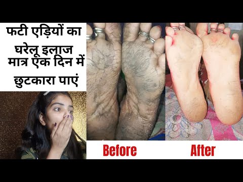 एक ही रात में फटी एड़ियों से छुटकारा पाएं| Get rid of crack heels in just one day | Shocking result