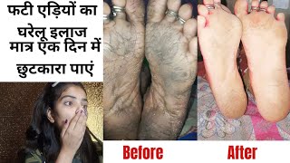 एक ही रात में फटी एड़ियों से छुटकारा पाएं| Get rid of crack heels in just one day | Shocking result