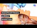 Nasopharyngeal Airway Management