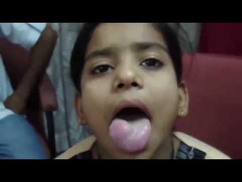 MND Patient Testimonial