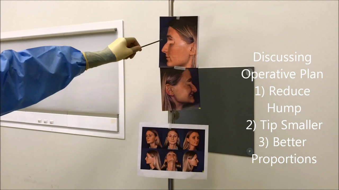 Discussing surgical plan for rhinoplasty procedure.