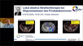 BPS Live-Onlinevortrag am 16.09.2020 - Lokal ablative Strahlentherapie bei Oligometastasen des PCa