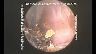 Clearance of cerumen impaction in the external ear canal 20250818