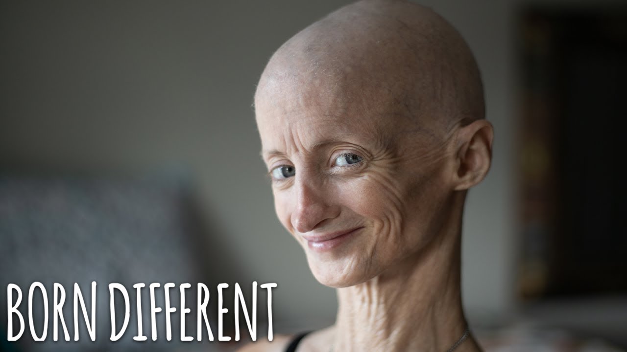 Progeria has taken my teeth but not my smile - born different