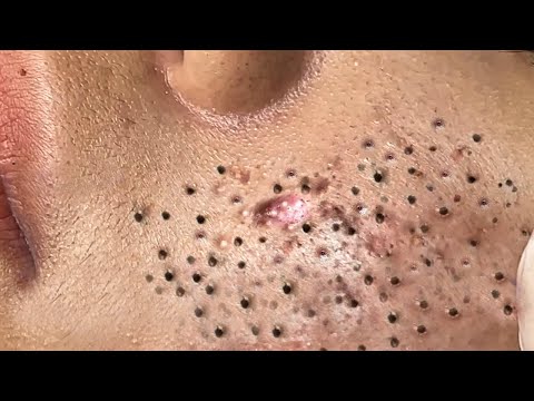 Blackhead Removal With Sac Dep Spa @100074212