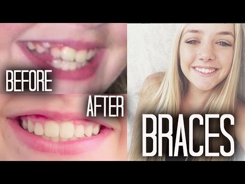 Braces 101 + Before & After!