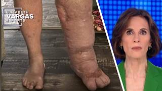 Flesh-eating bacteria survivor faces amputation for a better quality of life