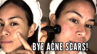 How I Got Rid of My Acne Scars