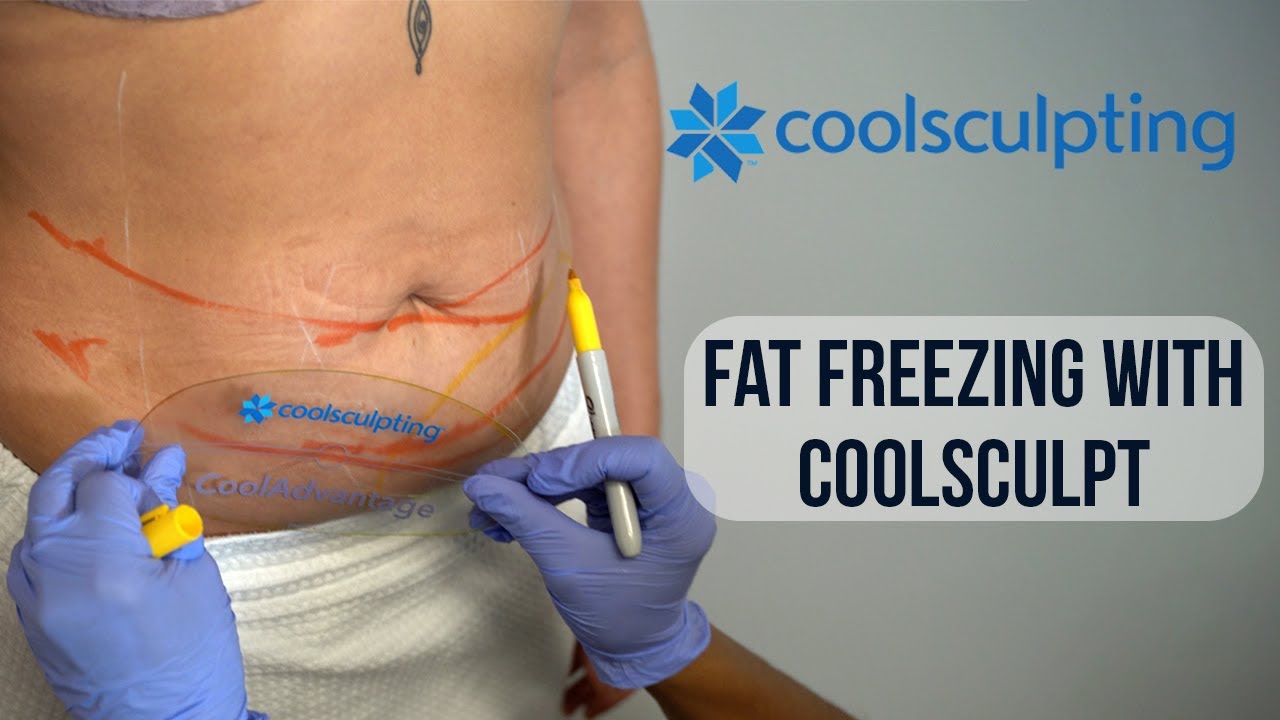 CoolSculpting fat freezing treatment in action