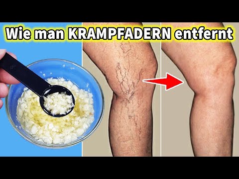 Nur mit diesen 2 Zutaten || Auf die Beine auftragen - Krampfadern schnell entfernen