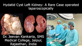 Laparoscopically operated Hydatid Cyst in the Kidney: A Rare Case