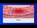 Understanding Skin Integrity and Pressure Injuries