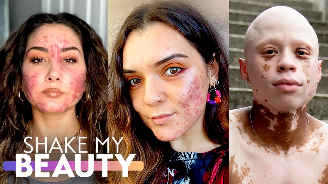Accepting our acne has made us stronger - shake my beauty