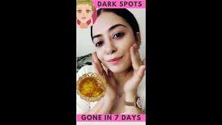 कितनी भी पुरानी झाइयां, Pigmentation जड़ से खत्म करें 100% रिजल्ट || How To Remove Pigmentation