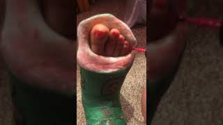 Painting toenails in leg cast- Nov 2019