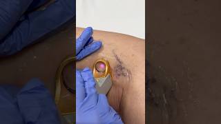Say goodbye to those visible veins!