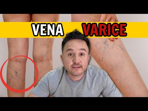 Los Secretos De La Vena VARICE Que NADIE Te Cuenta!