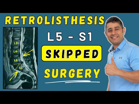 How to manage Retrolisthesis without surgery  (online client testimonial) #uae