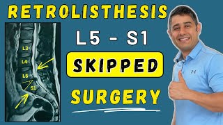How to manage Retrolisthesis without surgery  (online client testimonial) #uae