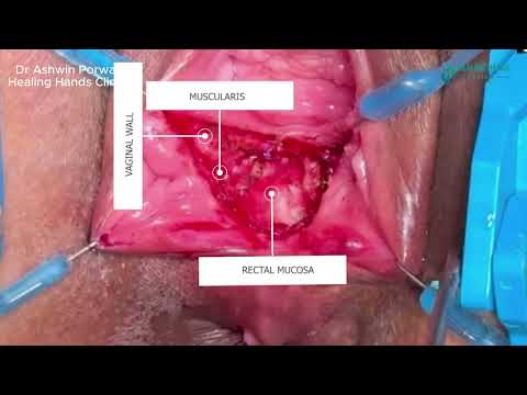 Canadian Woman Healed | 4.7 cm Rectovaginal Fistula Without Stoma | Dr. Porwal’s Advanced Technique