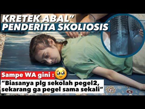 KRETEK ABAL2 ANAK YANG SKOLIOSIS JD BISA TERSENYUM LAGI.. ALHAMDULILLAH!