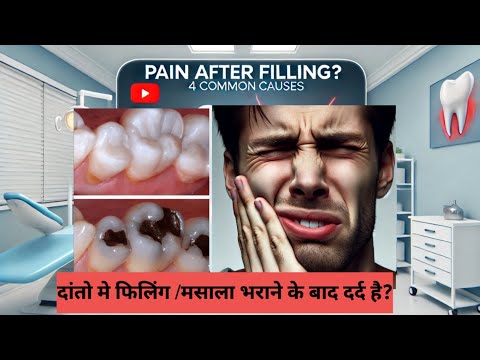 मसाला भराने के बाद दाँत मे दर्द है?4 Common Causes of Pain After a Tooth Filling (How to Fix Them)