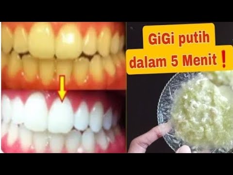 TERAMPUH‼️CARA CEPAT MEMUTIHKAN GIGI&MENGHILANGKAN BAU MULUT DAN KARANG GIGI.