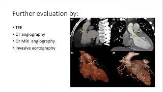 Echo Conference - Mostafa ElSawy : Supravalvular AS