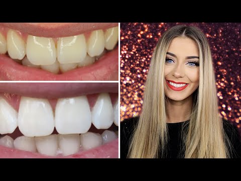 How I Whitened My Teeth at Home | Danielle Mansutti