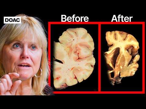 THIS Is The Fastest Way To Get Dementia… |  The Brain Doctor, Dr Ann Mckee