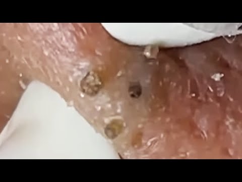 Blackheads & Whiteheads Satisfying Removal @0370