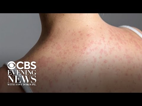 YouTube video thumbnail: South Carolina Measles Outbreak Explodes to Nearly 800 Cases