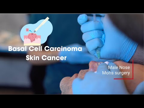 Male Nose; Mohs Surgery for Micronodular Basal Cell Carcinoma Skin cancer