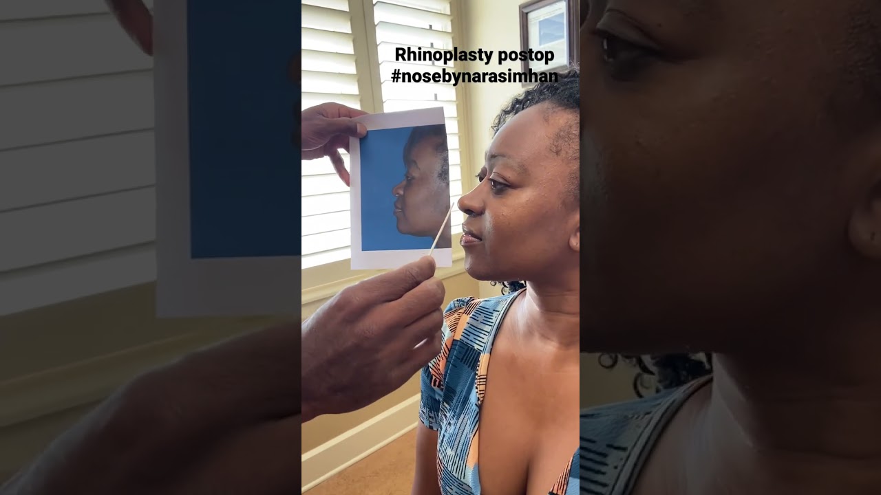Post-rhinoplasty consultation with before-and-after photo.