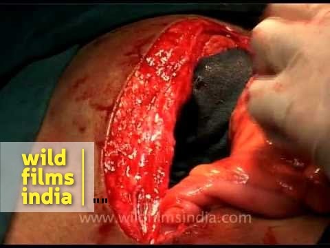 laparotomy abdominal laparoscopic