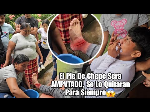 Chepe No Se Cuido😱, Ahora Perdera El Pie Para Siempre, Llorando Recibio La Noticia😭