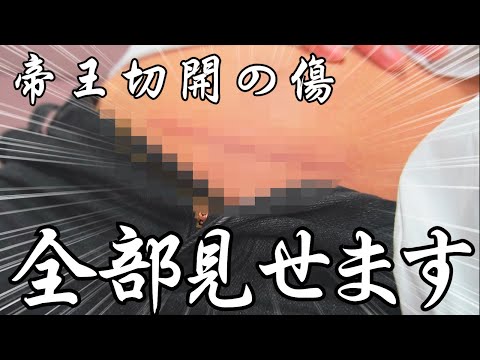 【初公開】一年後の帝王切開の傷口見せます