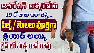 ఆపరేషన్ అక్కరలేదు ..15 రోజులు ఇలా చేస్తే ..పిల్స్ / మొలలు పూర్తిగా క్లియర్ | Piles | Dr. Ramchandra
