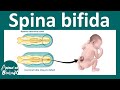 Understanding Spina Bifida and Neural Tube Defects