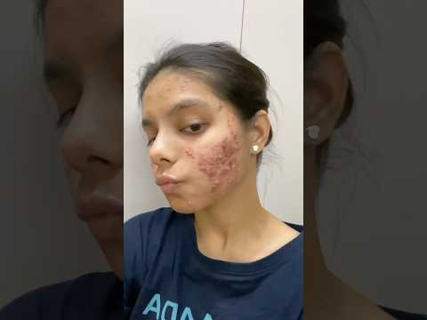 We have come a long way!!! 🥹🧿🙌 #youtubeshorts #acnejourney #severeacne #acnepositivity