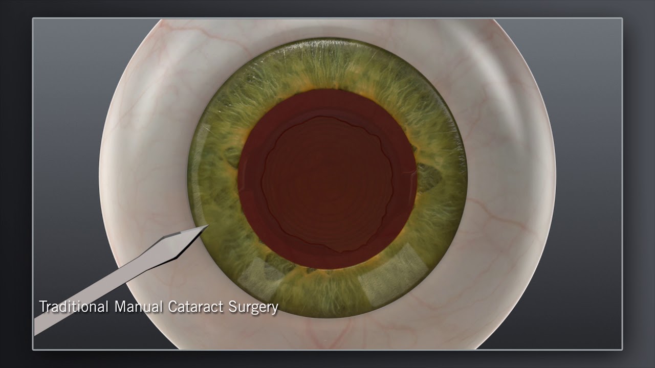 traditional manual cataract surgery