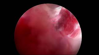 Recurrent Colloid Cyst Resection with the LOTTA® Ventriculoscope