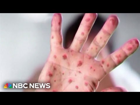 YouTube video thumbnail: Los Angeles Child Dies of Complications From Measles Virus