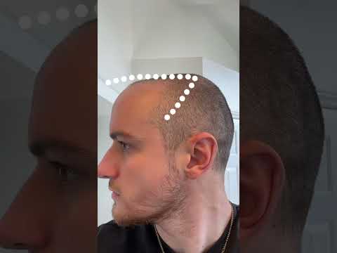 Trust the process #hair #hairtransformation #hairgrowth #hairtransplant #bald #shave #hairline