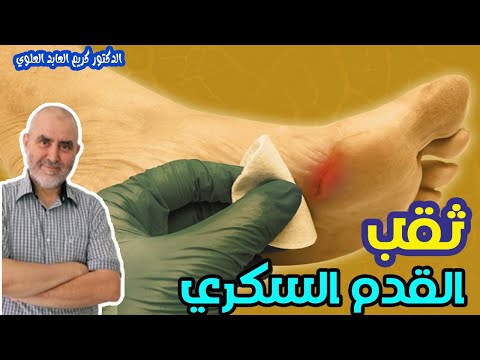 مشكل قرح القدم السكرية    -    الدكتور كريم العابد العلوي   -
